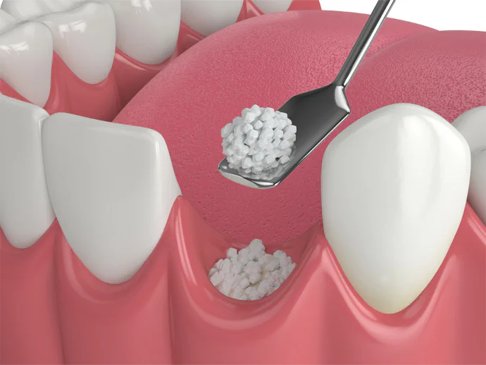 Dental bone grafting in Sandy Shore, MD at Magnolia Family Dental