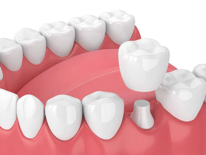 Dental Crowns and Bridges in Sandy Shore, MD at Magnolia Family Dental