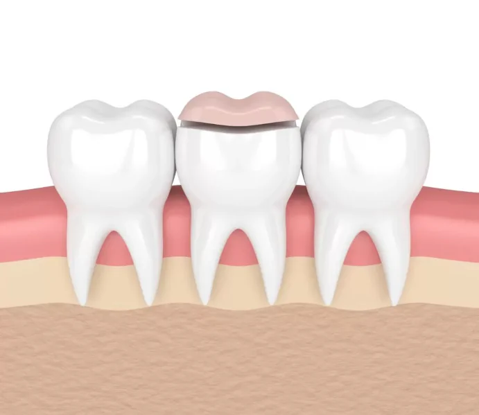 Dental Inlays and Onlays in Sandy Shore, MD at Magnolia Family Dental
